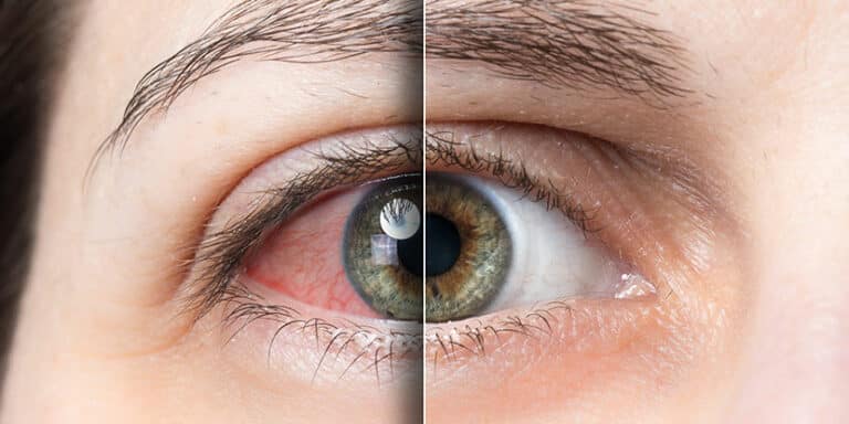 Red irritated eye vs, clear healthy eye