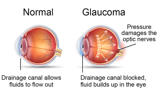 Glaucoma compare