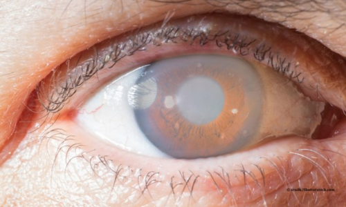 Dry Eye/Blepharitis