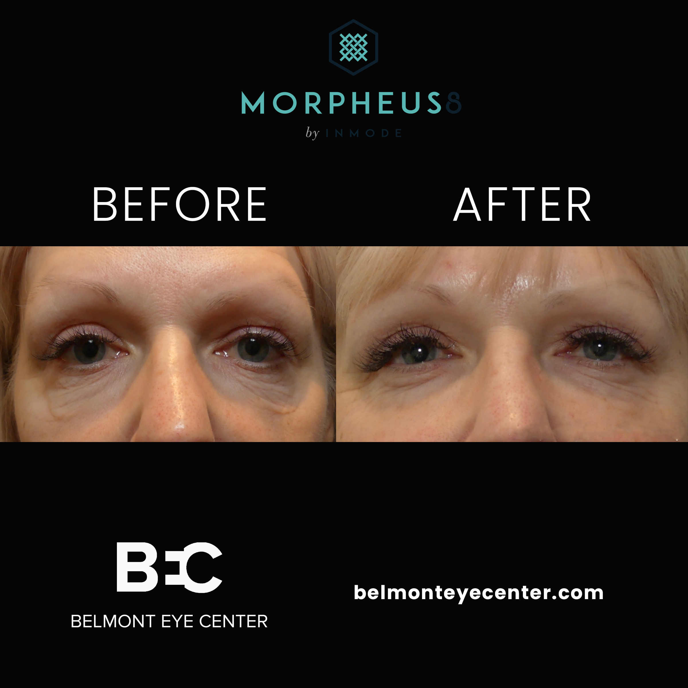 before after morpheus8 copy
