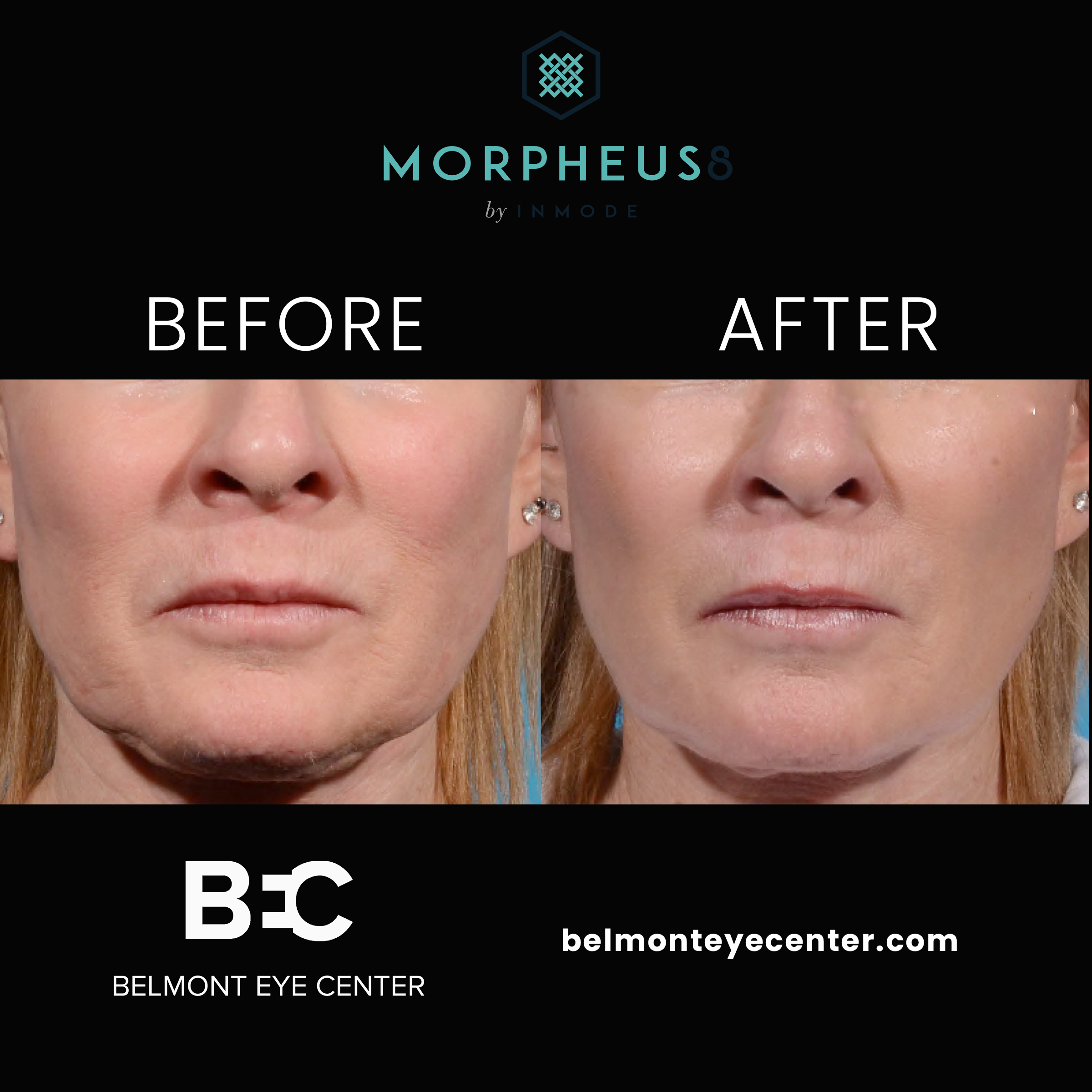 before after morpheus8 jowls