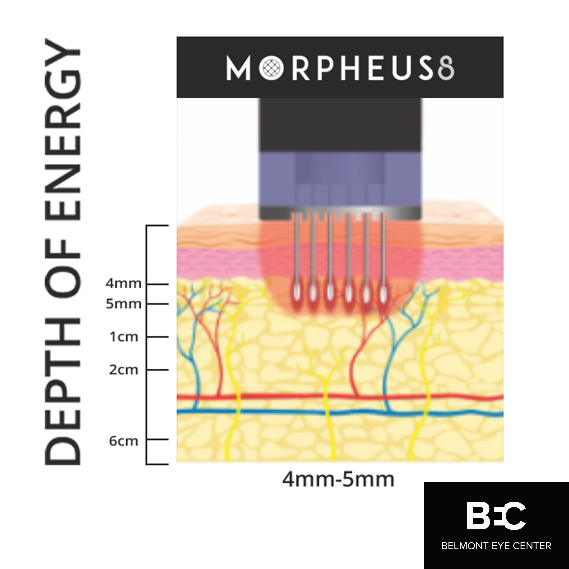 morpheus8 diagram depth