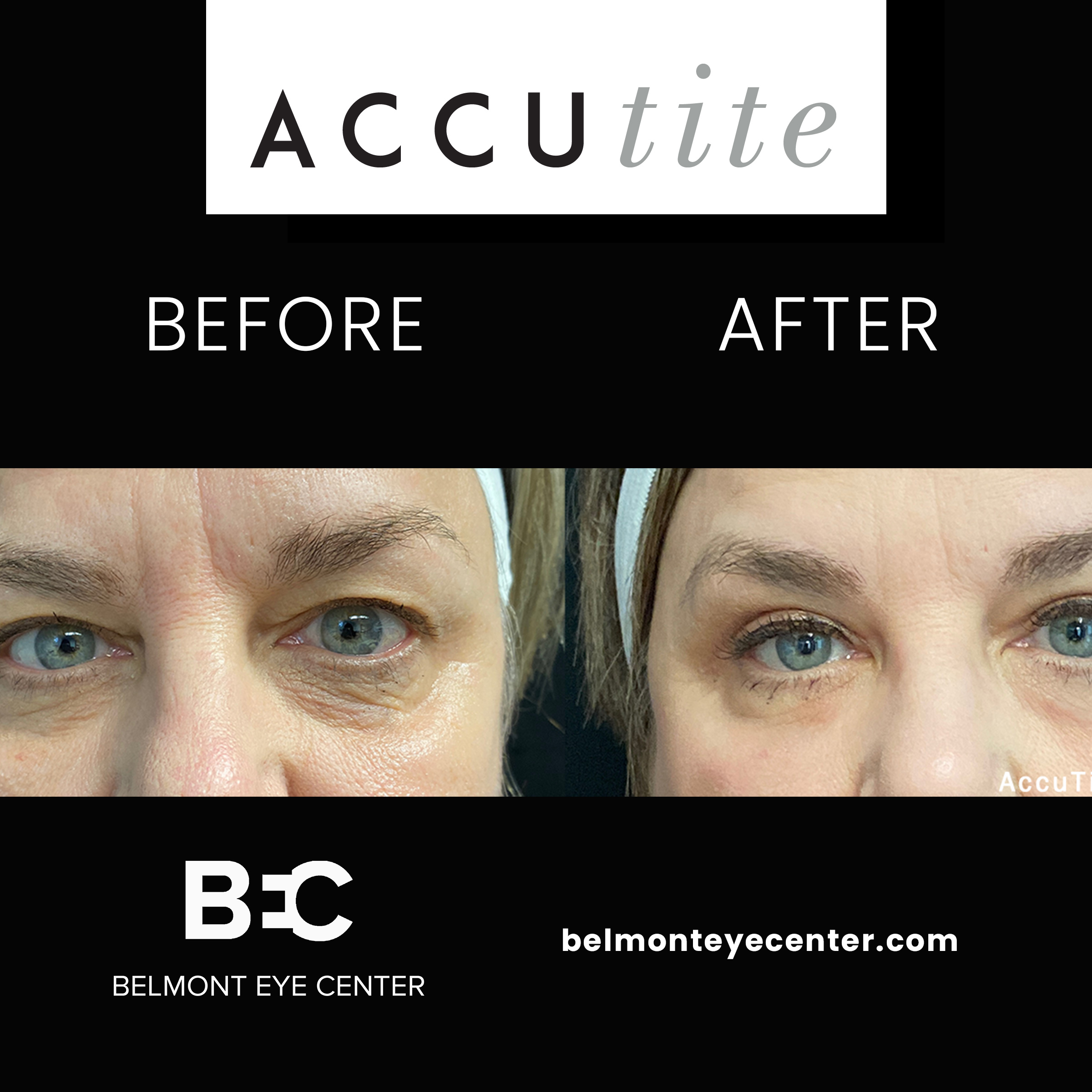 before after accutite