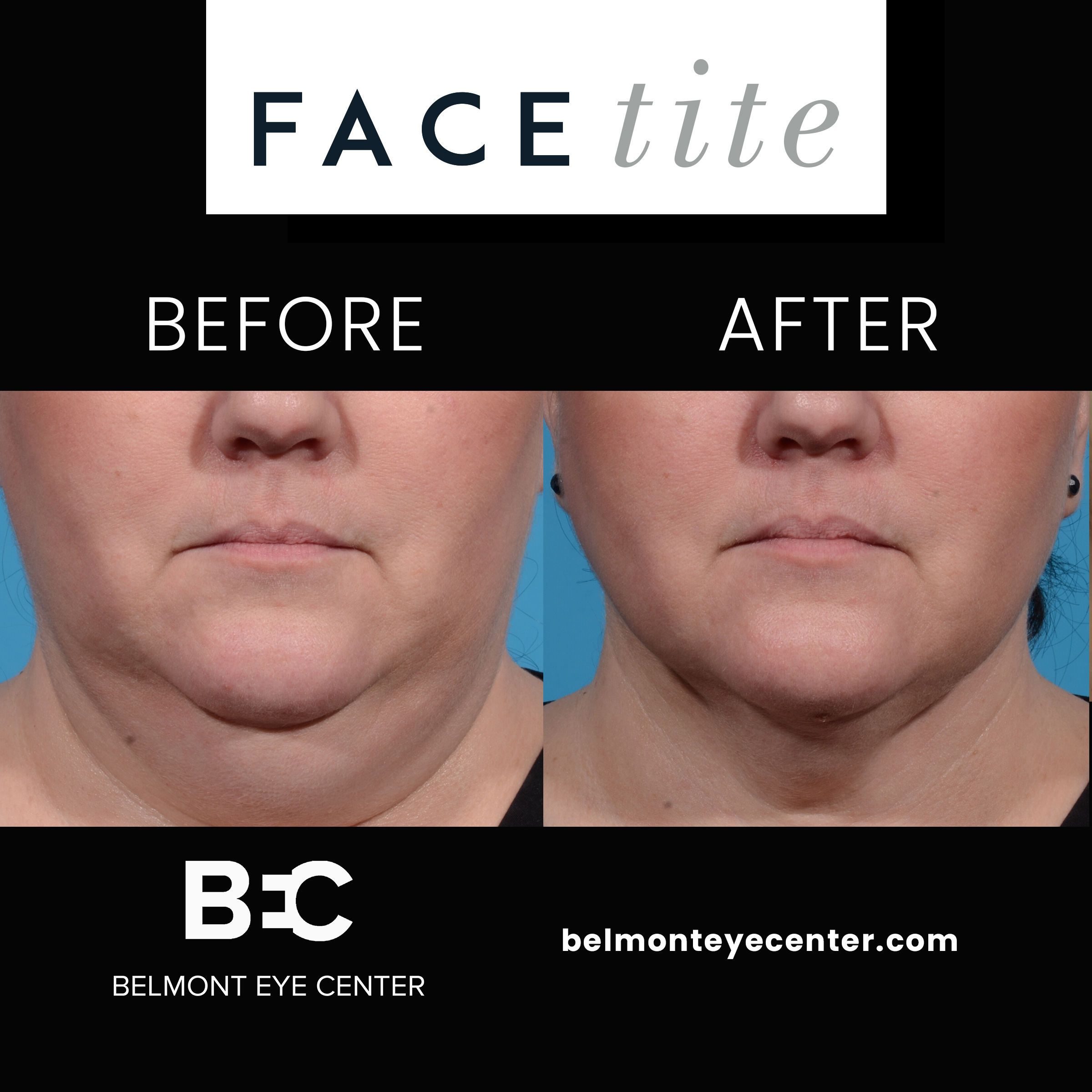 before after facetite 1