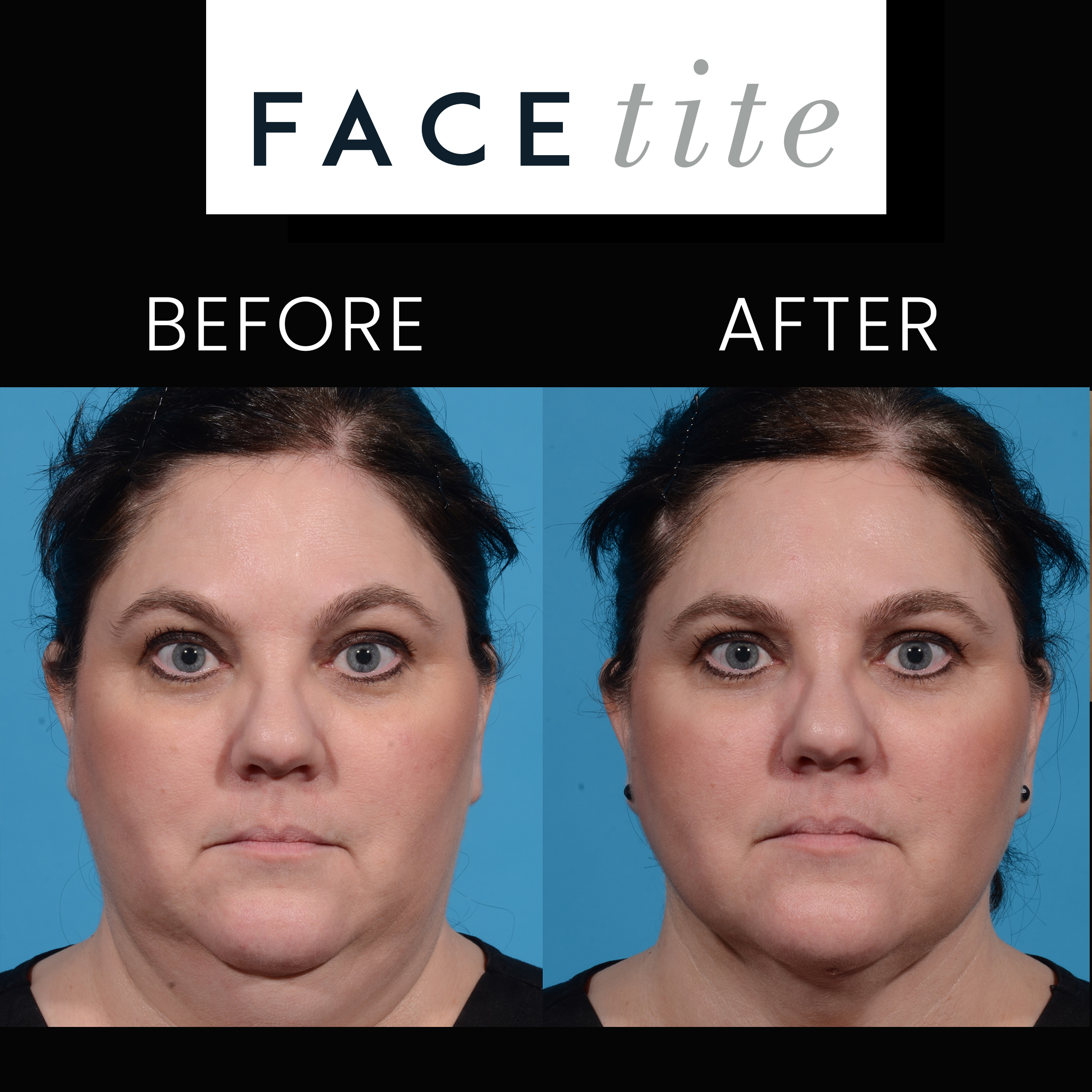 before after facetite 2