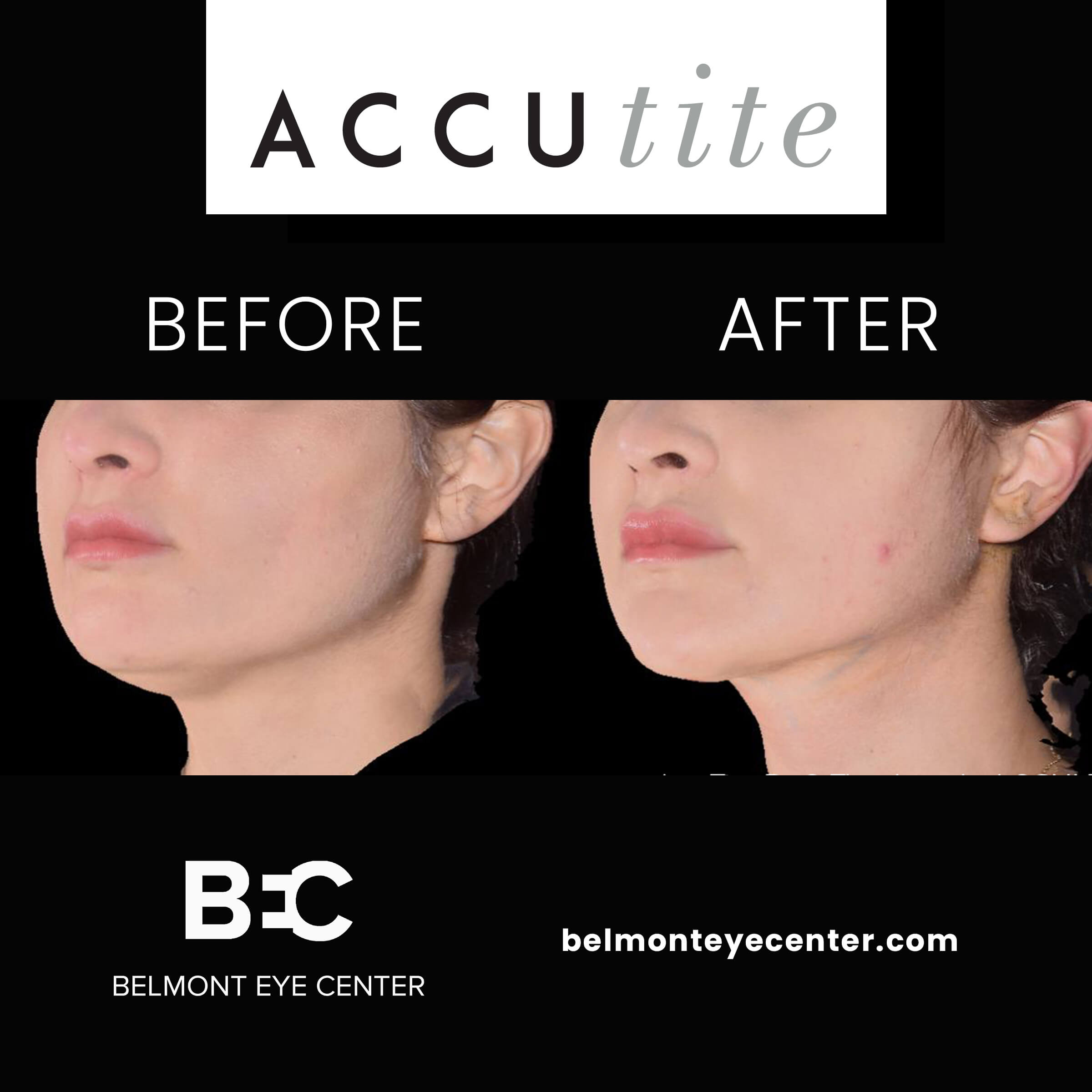 Before and After ACCU Tite Treatment