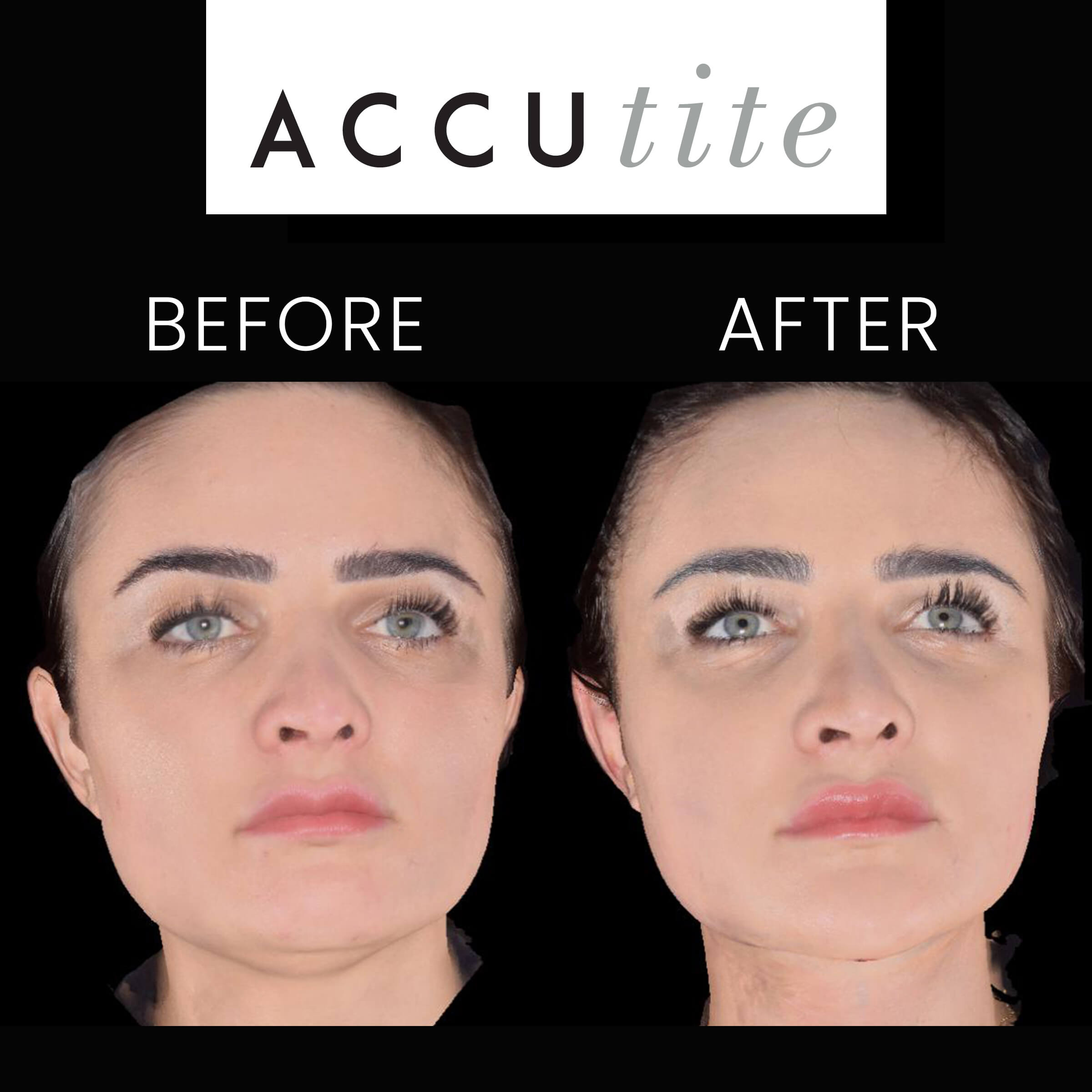 Before and after ACCU tite of a Woman