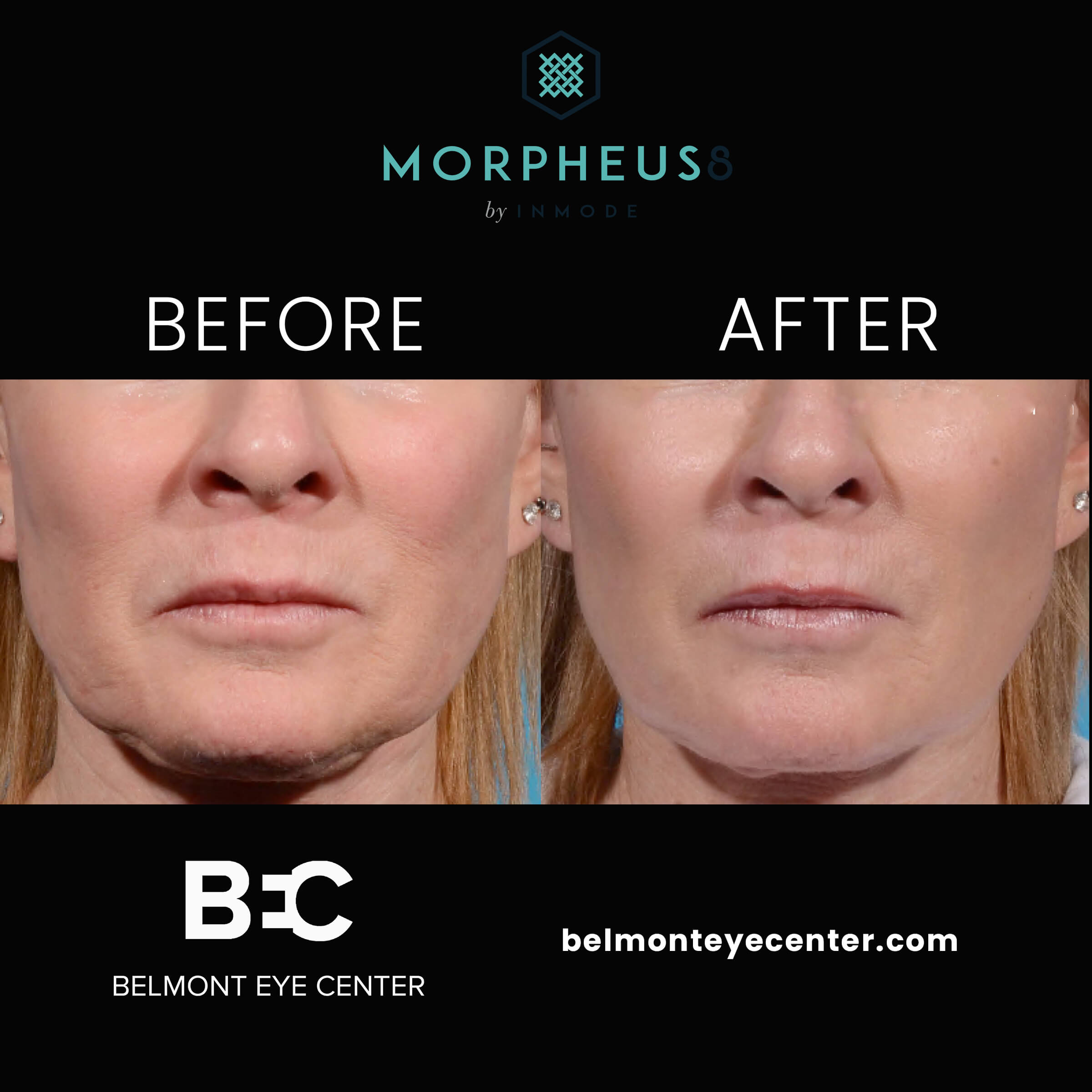 Morpheus Treatment on a Woman Before and After