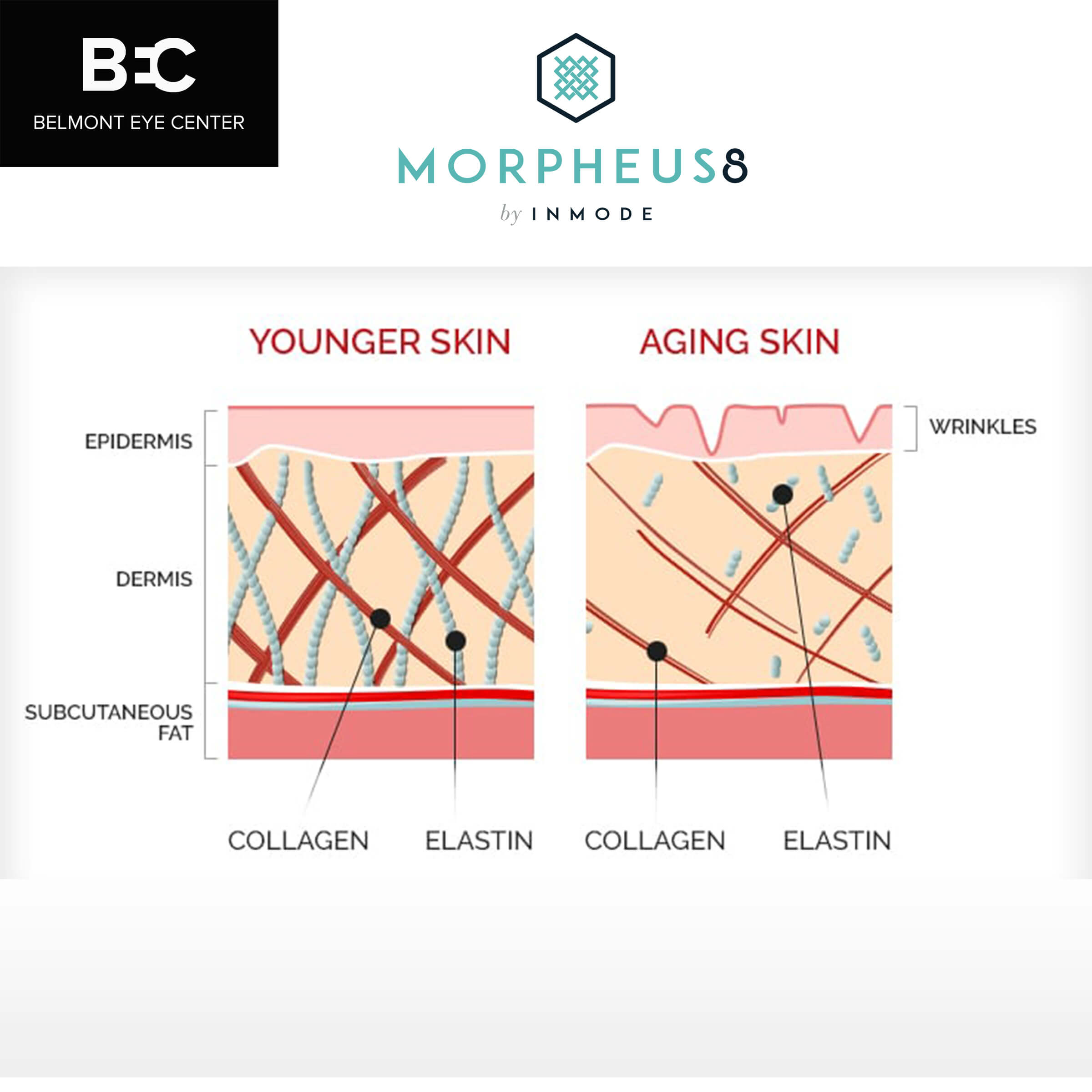 A Aging and Younger Skin Diagram With Label