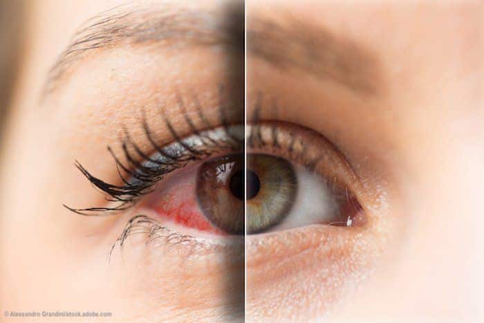 Bloodshot eye compared to healthy eye