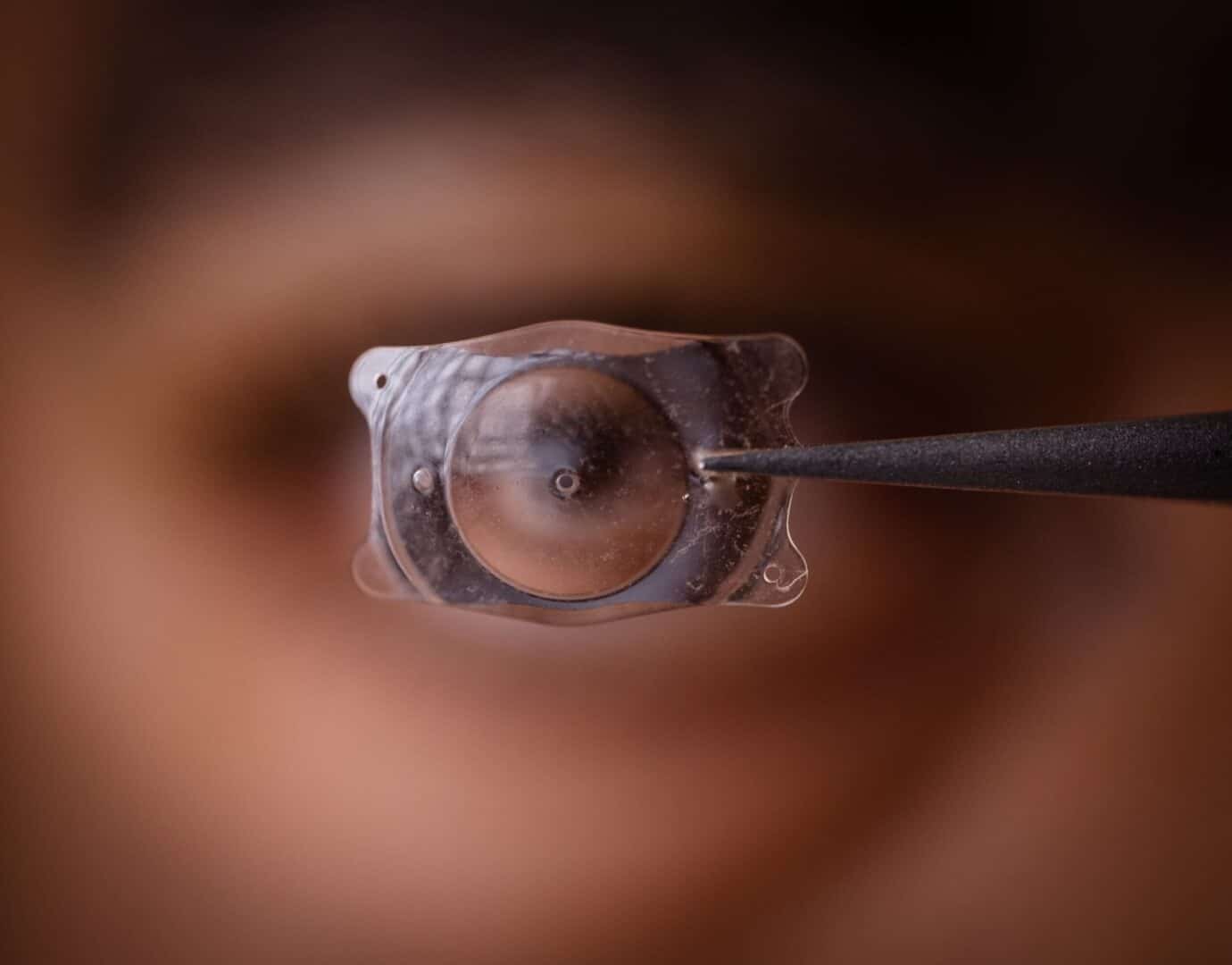 Glaucoma: The Silent Thief of Sight