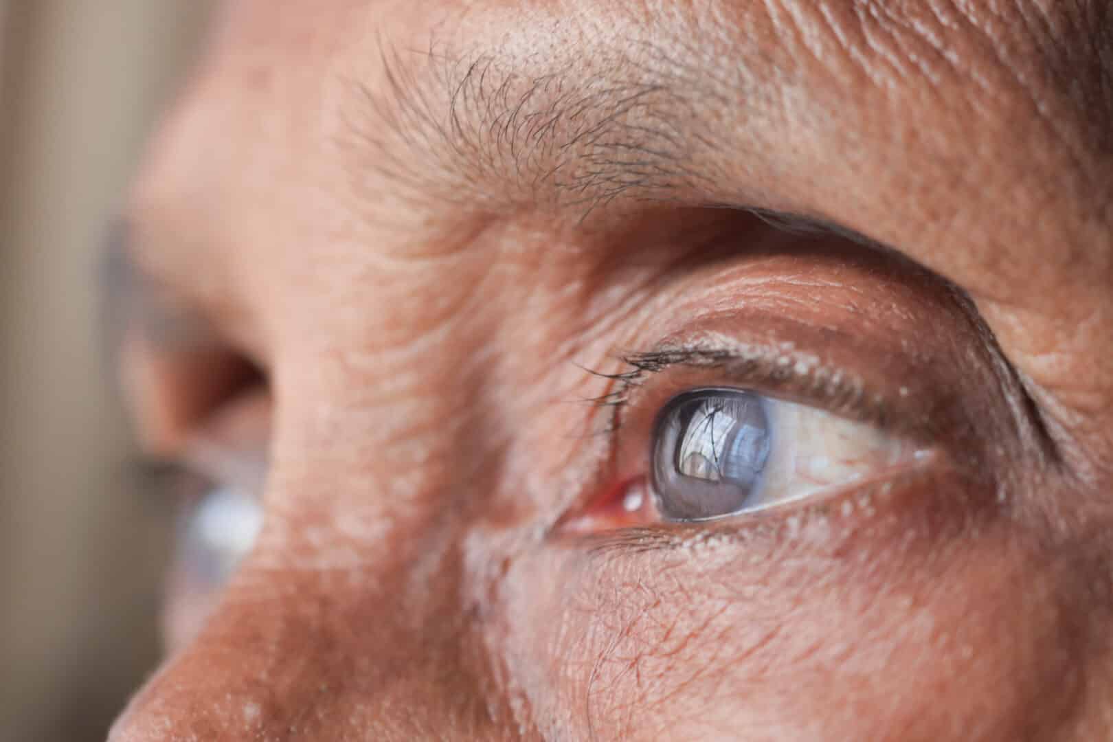 Understanding Cataracts: Causes, Symptoms, and Treatment Options