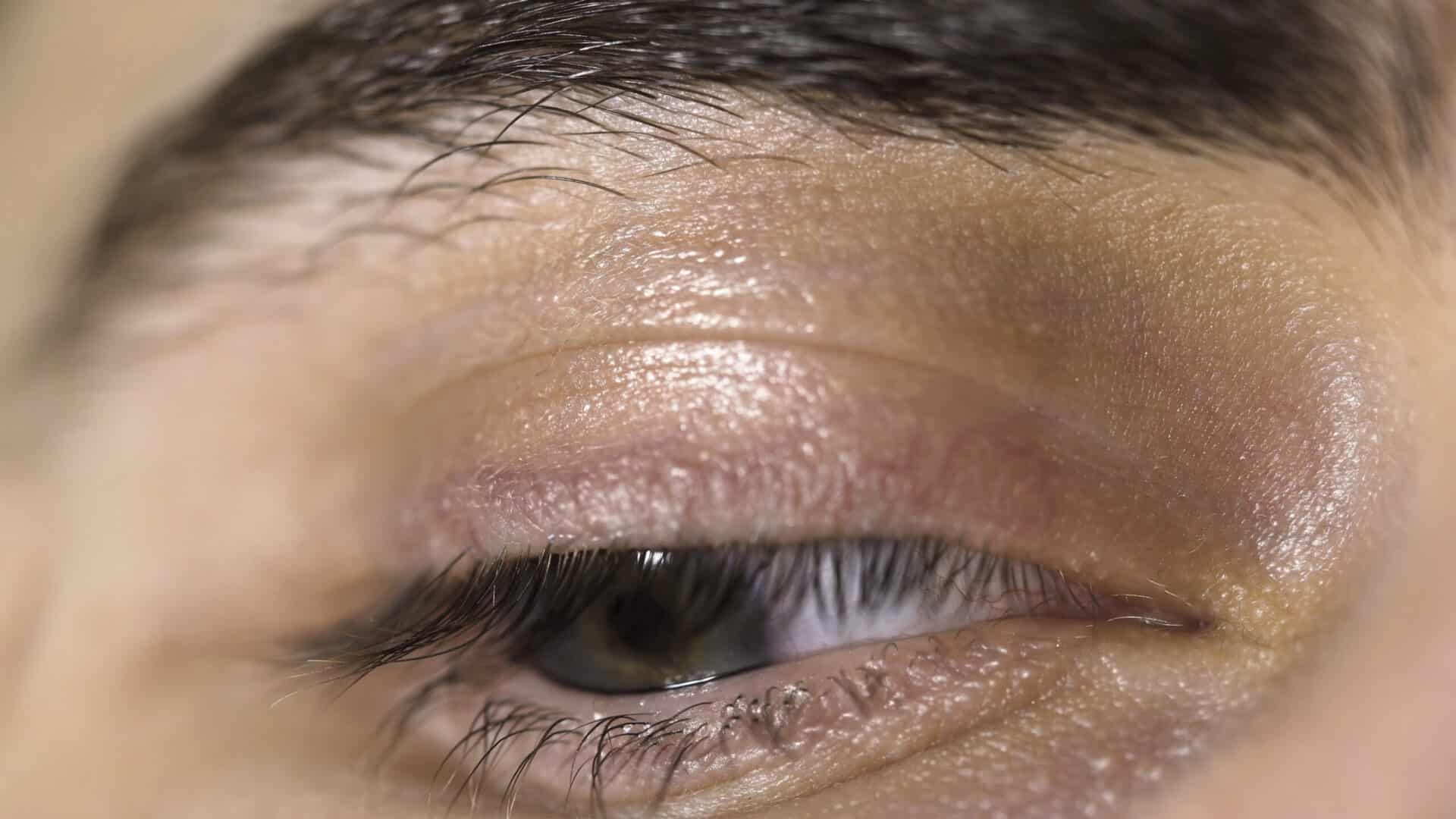 Demodex Mites and Blepharitis: The Hidden Cause of Irritated Eyelids