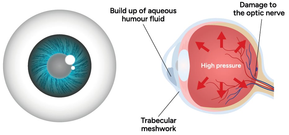 An Eye With Glaucoma