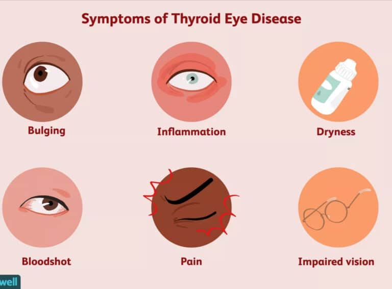 Symptoms of Thyroid Disease