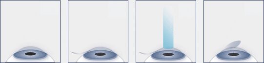 A diagram illustrating the steps of LASIK eye surgery.