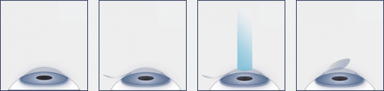 Chart showing the lasik surgery process