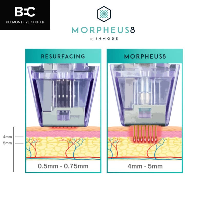 morpheus8 diagram