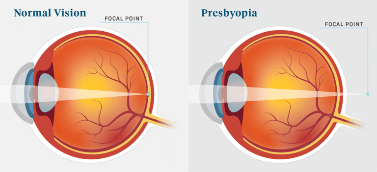 presbyopia a common eye condition related to aging